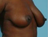 Patient # 12843 Before Photo # 3
